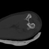 SPORK, NICO - 22.03.1976 - 02.08.2022 - CT obere Extremität - 18:02:23